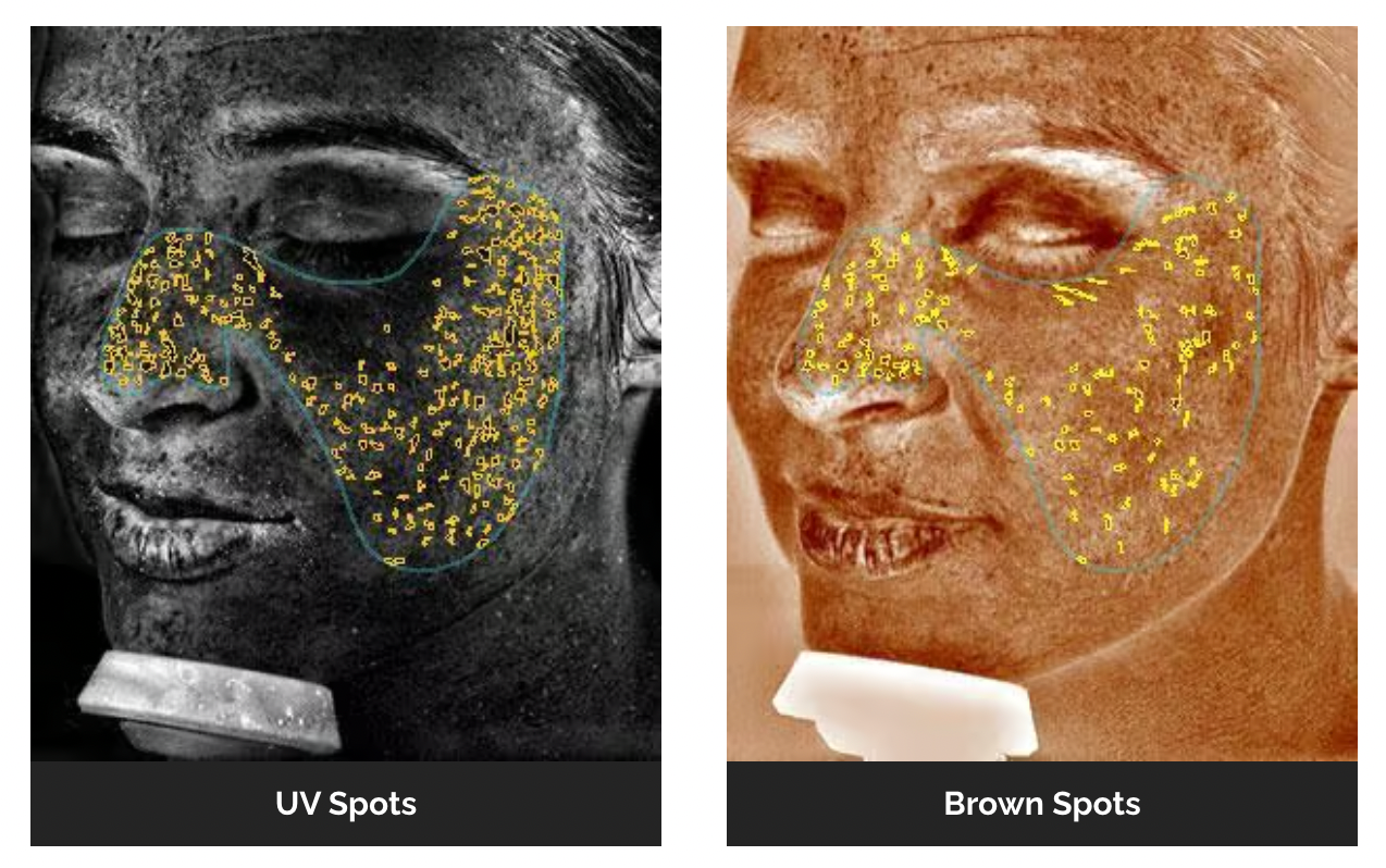 Visia skin analysis showing UV spots and brown spots