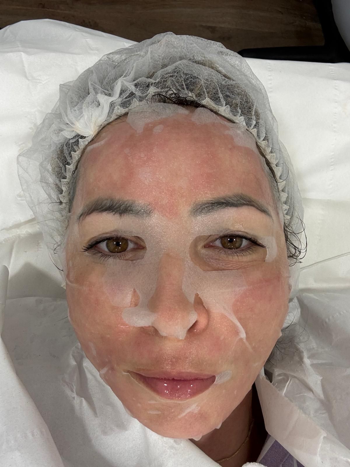 my face post xcellaris pro twist microneedling treatment