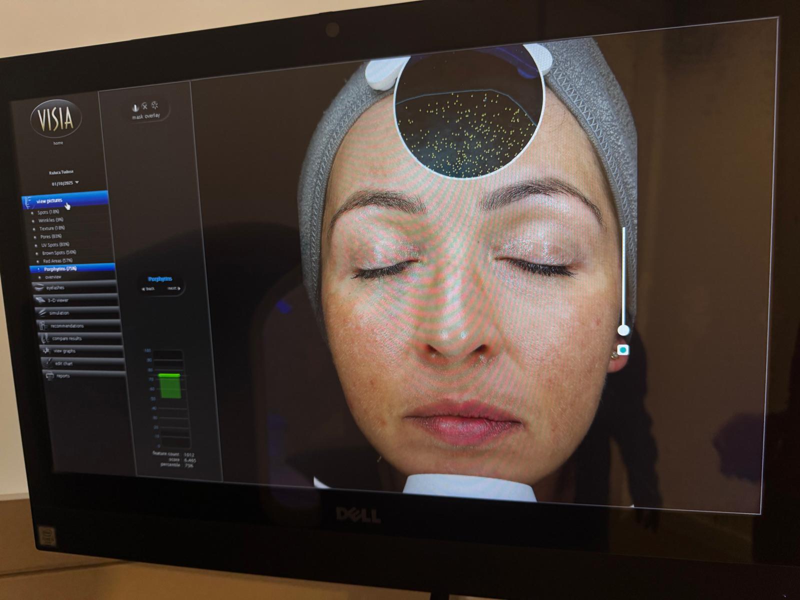 Visia Skin Analyser